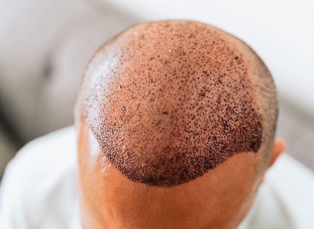 After hair transplantation surgical technique that moves hair follicles. Young bald man with hair loss problems.